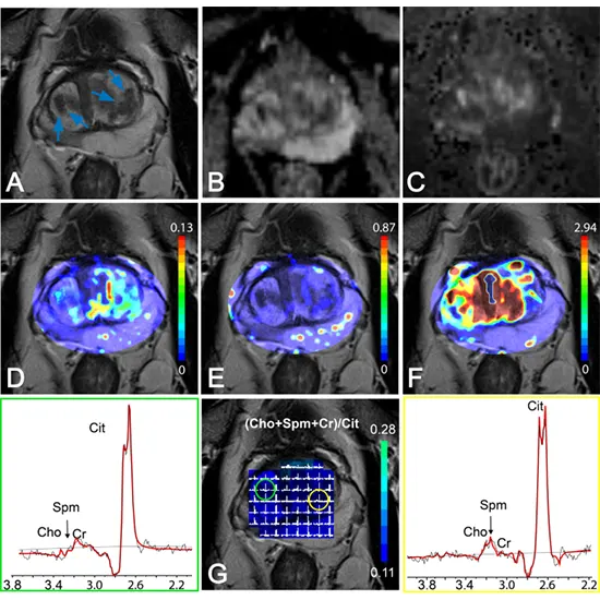 Multiparametric MRI Test Price In Delhi Cost Near Me India Multiparametric MRI Test Price In Delhi Cost Near Me India